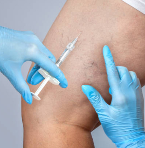 Escleroterapia